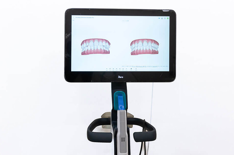 3D光学スキャナー「iTero」を導入し、さらに快適で安心の治療に